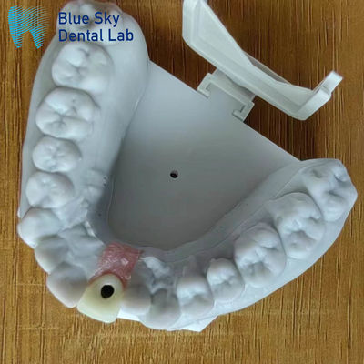 주문 증기 살균 단일 임플란트 왕관 부드러운 표면 치아 임플란트 왕관 online manufacture