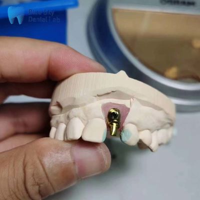 주문 일반 임플란트 케이스 맞춤식 단일 임플란트 치아 오프셋 아치 임플란트 케이스 online manufacture
