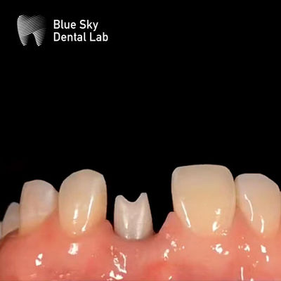 주문 항 알레르기성 치아 임플란트 Zirconia Abutment 생물 호환성 online manufacture