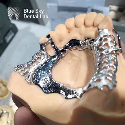 주문 블루 스카이 치과 프레임 부분 턱 치아 주름 금속 프레임 online manufacture
