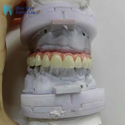 자연 인공 치아 임플란트 케이스 맞춤형 전체 입 임플란트 케이스