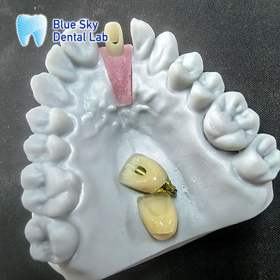 정밀 밀링 Zirconia 단 하나의 임플란트 왕관과 함께 아부트먼트