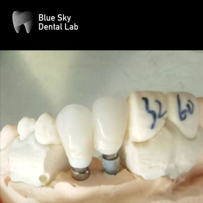 단일 왕관 Zirconia Abutment 하이포 알레르기성 치아 임플란트 Zirconia Abutment