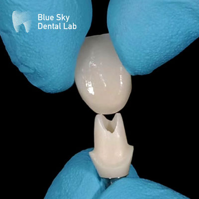 구강 스캔 사용자 지정 Zirconia Abutment 고강도 Zirconia Abutments